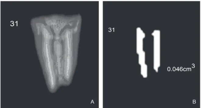 Figure 1. CT scan of the filling material in the root canals before filling material removal (A) and the selected filling material and its volume calculated in cm 3  before the removal procedure (B).