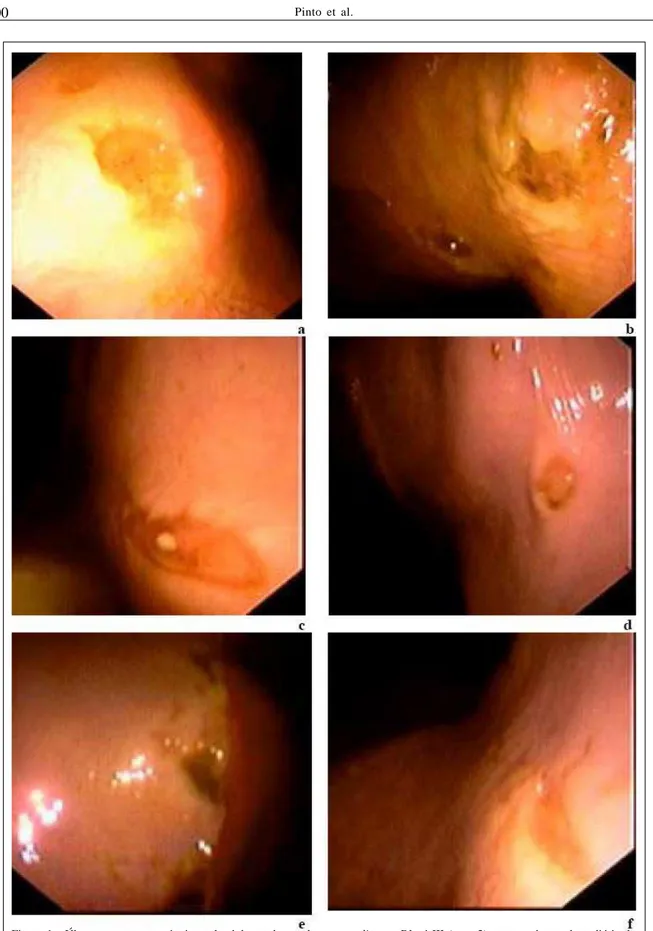 Figura 1 - Úlceras na mucosa gástrica aglandular ao longo do margo plicatus. Pônei III (grau 2), que recebeu a dose diária de 6mg kg -1  de monofenilbutazona (primeira etapa) (a e b)