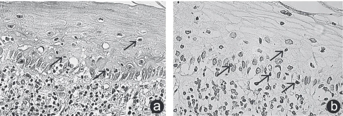 Figure 2. Photomicrographs of the erosive form of OLP. A=  Shorr staining. Disruption of the epithelial basal layer with apoptotic cells surrounded by a clear halo, hyaline (“Civatte bodies”), and an intense subepithelial inflammatory infiltrate (×40 objec