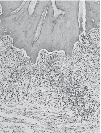Figure 5. Greater magnification of Figure 4 showing apical cementum resorption and inflammatory cell infiltrate