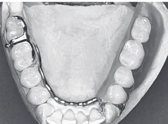 Figure 4. Definitive view of mandibular treatment. A= Note the slight visibility of the RPD retention elements and the pleasant appearance of the characterized denture base; B= Smiling not exposing the retention elements of the RPD; C and D= Definitive vie