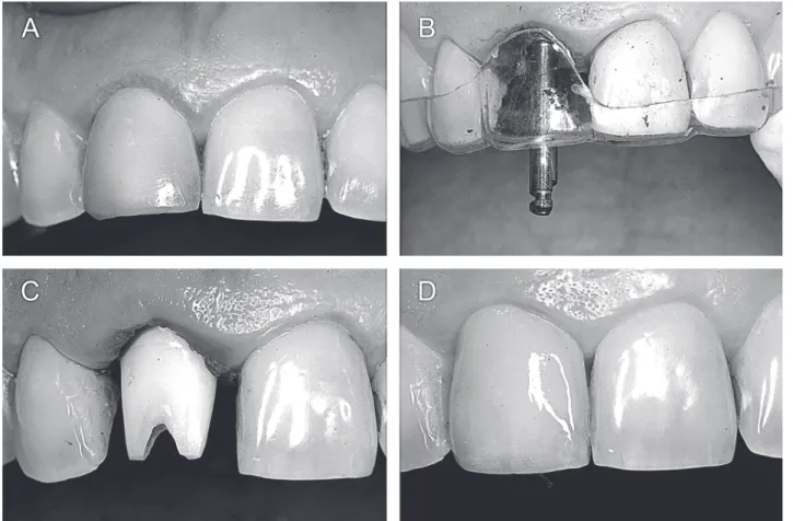 Figure 1. A= Maxillary right central incisor with a fractured root; B= Relationship between the surgical bur and the stent shows an ideal three-dimensional position; C= Definitive zirconia abutment installation; D= Definitive metal-free crown installed aft