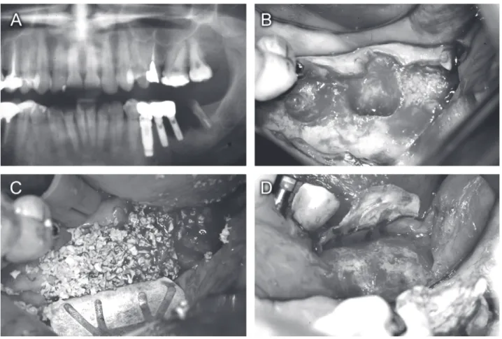 Figure 2. A= Large radiolucent image associated with the implants and distal root of a hemi-sectioned 2nd molar; B= Bone defect after implant removal and tooth extraction; C= Mix of autogenous bone graft and Bio-Oss covered by a TR6W titanium reinforced Go