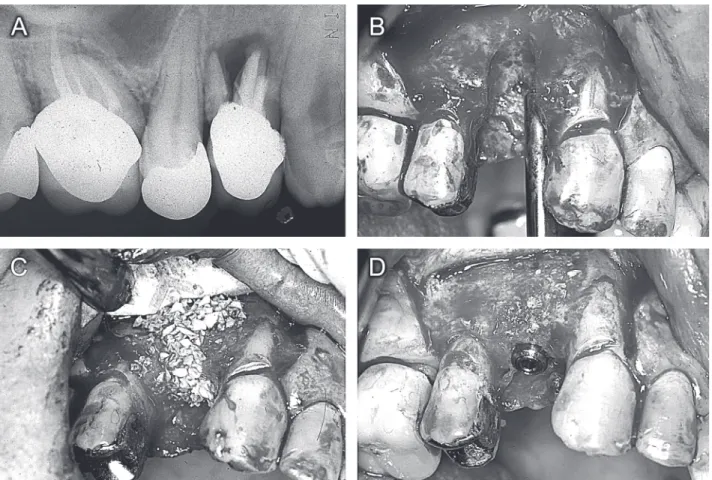 Figure 3. A= Large radiolucent image associated with tooth14; B= Three-wall defect observed after tooth extraction; C= Guided bone regeneration with Bio-Oss and TR4Y titanium reinforced Gore-Tex membrane; D= Implant installed after 6 months.