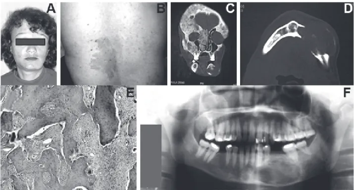 Figure 1. Fibrous dysplasia (FD) and McCune-Albright syndrome (Case 1). A= Facial asymmetry is visible in the left side of the mandible with FD; B= Typical café-au-lait pigmentation (hypermelanotic maculae) on the patient’s back; C= CT scan showing lytic a