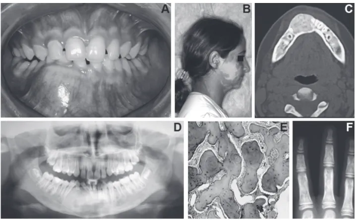 Figure 2. McCune-Albright Syndrome (Case 2). A= Mandibular expansive lesion with discreet facial asymmetry; B= Café-au-lait cutaneous spots on the face; C= CT scan showing a well-defined hyperdense image, with a denser peripheral contour; D= Panoramic radi