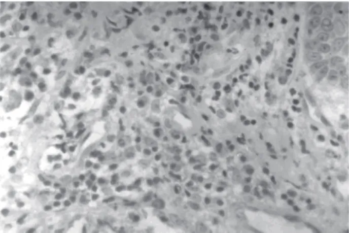 Figure 2. Chronic periodontitis. Diffuse distribution of CD25+