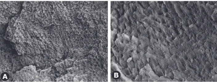 Figure 4. Enamel surface etched with Er:YAG laser and 37% phosphoric acid for 30 s. The topographical view of the surface is more similar to the etching patterns produced by 37% phosphoric acid gel treatment (SEM ×500-A and ×2000-B).