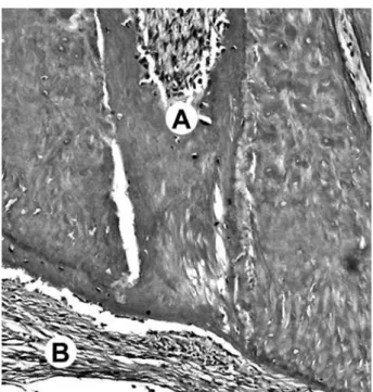 Figure 2. AH Plus. Image of the apex showing partial biological  seal by deposition of mineralized  tissue (A) and mild inflammatory  cell infiltrate (B)