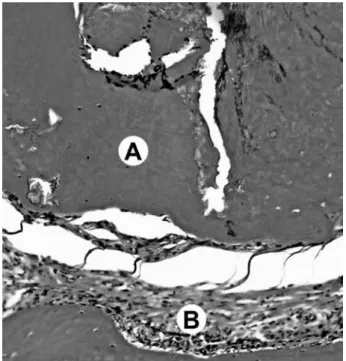 Figure 3. RoekoSeal.  Image of the apex showing partial biological  seal by deposition of mineralized tissue (A) and mild inflammatory  cell infiltrate (B)