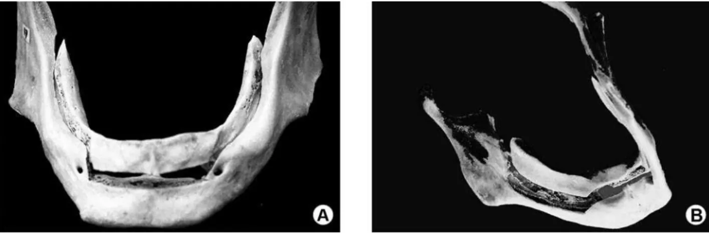 Figure 4. Different views of modified visor osteotomy in a dry mandible.