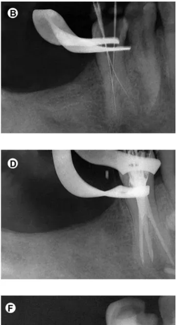 Fig. 1. Panel of periapical radiographs documenting teh case. A = Preoperative radiograph; B = Working length determination; C =  Selection of the main gutta-percha cones; D = Testing of the canal filling; E = Final obturation; F = 1-year follow-up.
