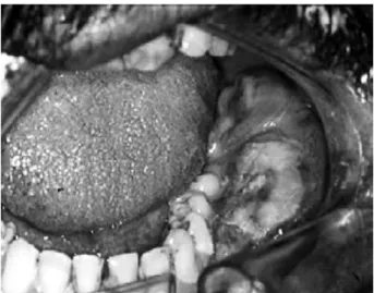 Figure  2.  Partial  view  of  the  panoramic  radiograph  showing  a  discrete  radiolucent  area  with  ill-defined  limits  sited  in  the  bifurcation  of  the  first  and  second  molars