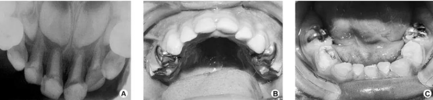 Figure 3. rehabilitation comprising endodontic treatment and placement of stainless steel crowns, amalgam and composite restorations.