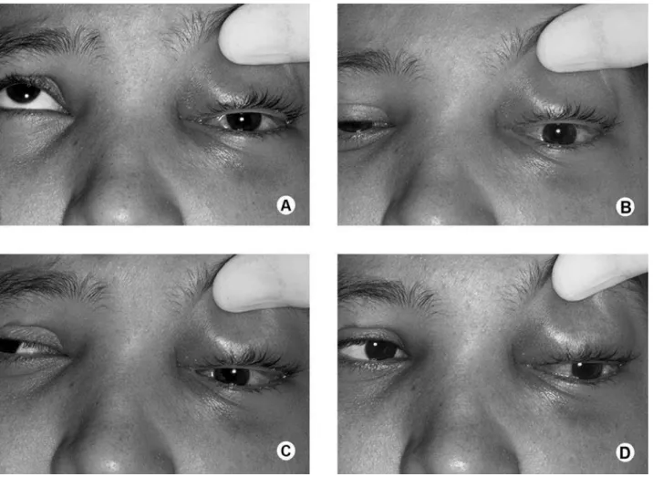 Figure 2. Ocular motility during the initial exam showing limitation of ocular movement upwards (A), downwards (B), to the right  (C) and to the left (D).