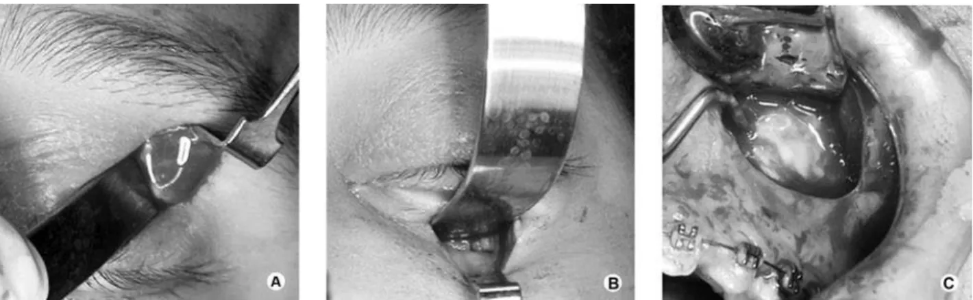 Figure 4. Intraoperative photographs. The orbit was drained superiorly (A) as well as inferiorly (B)