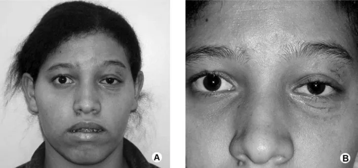 Figure  6.  Postoperative  photographs. A  =  Facial  appearance  on  the  12th  postoperative  day