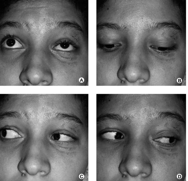 Figure 7. Ocular motility exam during 12th postoperative day showing normal ocular movement upwards (A), downwards (B), to the  right (C) and to the left (D).