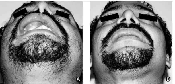 Figure 5. Comparative preoperative and postoperative images. A. Initial photograph. B