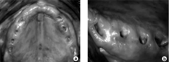 Figure 2. Clinical aspect of the maxillary alveolar ridge 3 years after surgery showing normal oral mucosa around the insertion sites (A, B)