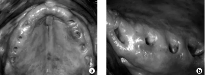 Figure 2. Clinical aspect of the maxillary alveolar ridge 3 years after surgery showing normal oral mucosa around the insertion sites (A, B)