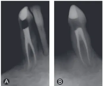 Figure  2.  Final  radiographs.  A:  Mandibular  right  canine;  B: 