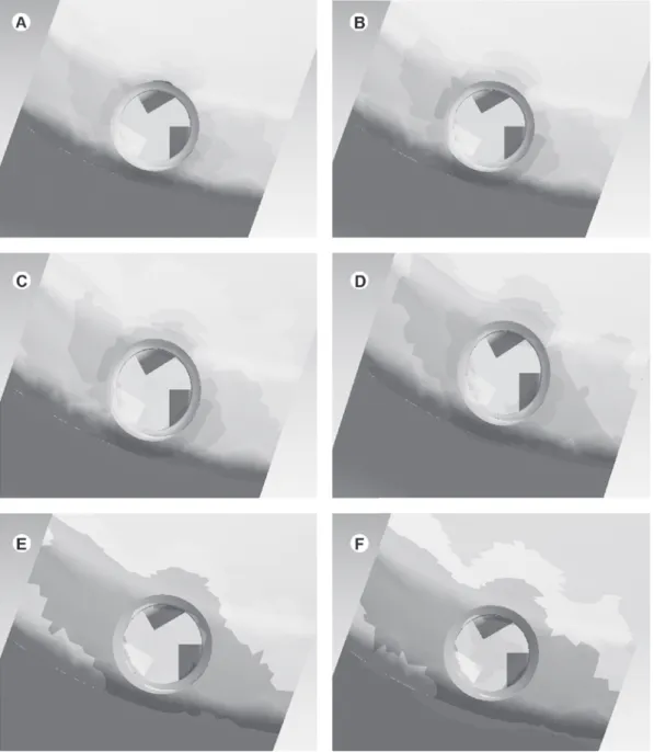Figure 3. Stress profile within cancellous bone at each torque insertion. A= 30 Ncm; B= 40 Ncm; C= 50 Ncm; D= 60 Ncm; E= 70  Ncm; F= 80 Ncm