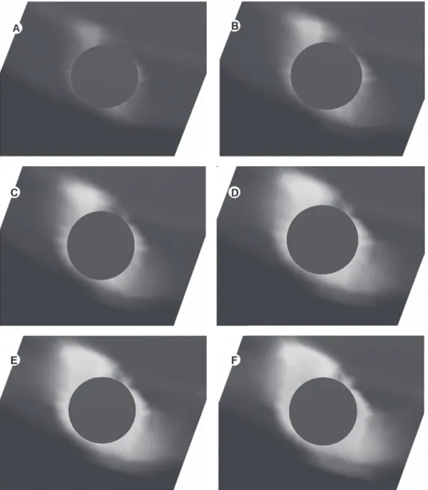 Figure 4. Stress profile within cortical bone at each torque insertion. A= 30 Ncm; B= 40 Ncm; C= 50 Ncm; D= 60 Ncm; E= 70 Ncm; 