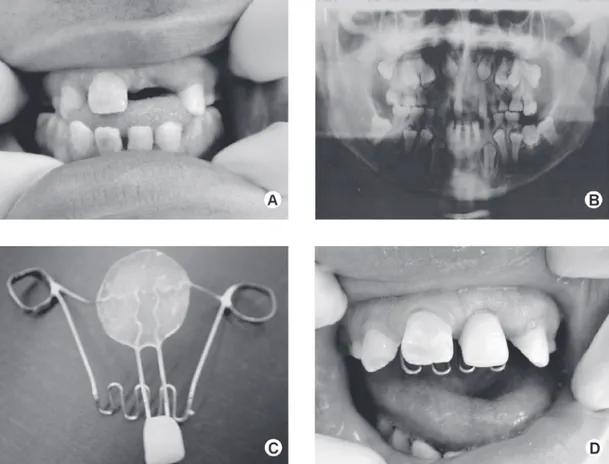 Figure 1. Panel of clinical and radiographic images showing the provisional rehabilitation of the missing anterior tooth