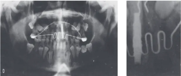 Figure 3. Four-year follow-up of the case with orthopantomogram (A) and periapical radiograph (B).