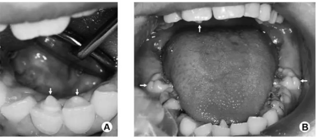 Figure 2. Intraoral clinical images. A: Talon cusps on lingual surfaces of both mandibular central incisors