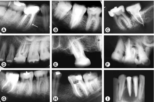 Table 1. Quality of fillings as a function of root canals groups.