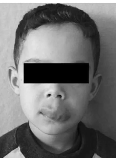 Figure 1. Preoperative frontal views of the patient at the age of  4 with a large hemangioma of the upper lip.