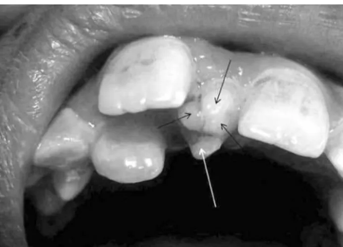 Figure  2.  Image  of  the  same  mesiodens  causing    occlusal  interference.