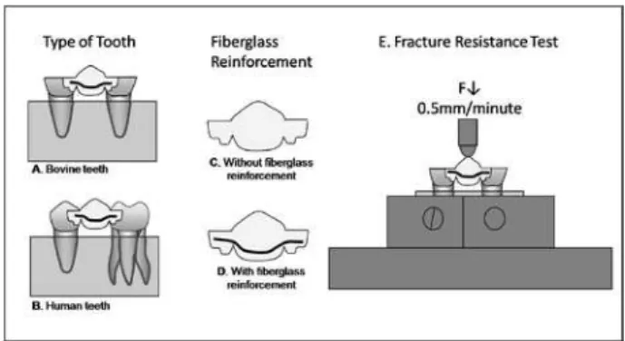 Figure 1. Schematic view of procedures. Type of tooth factor: 