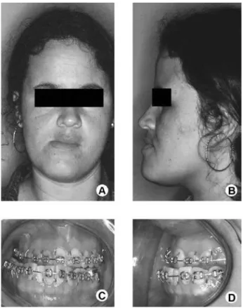 Figure  1.  Clinical  preoperative  facial  appearance.  A=  Chin  deviation to the right side; B= Lateral view showing mandibular  prognathism;  C=  Midline  deviation  and  malocclusion;  D= 