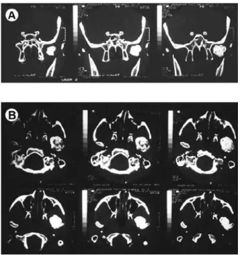 Figure 3. CT scans. A = Sequences of coronal CT images in bone  window showing irregular mass of mineralization in the condyle