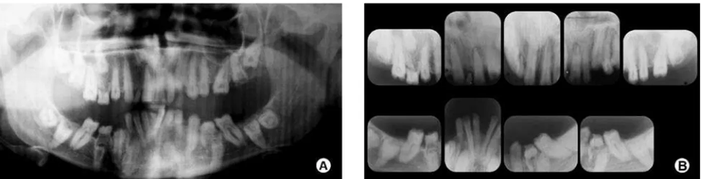 Figure 1. View of the maxillary and mandibular teeth in occlusion  revealing  neither  anterior  open  bite  nor  gingival  enlargement  around  the  teeth  present  in  the  oral  cavity