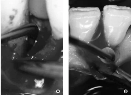 Figure 2. Intraoperative view of scaling and root planing at an intra-bony defect (A)