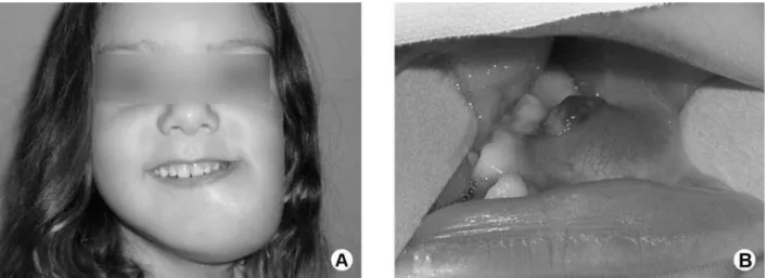 Figure 1. (A) Extra-oral presentation of tumor, showing significant increase in angle of left mandible