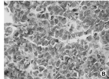 Figure 3. (A) Photomicrograph (HE staining) showing a monotonous population of small round cells with hyperchromatic nuclei,  inconspicuous nucleoli, and scant cytoplasm
