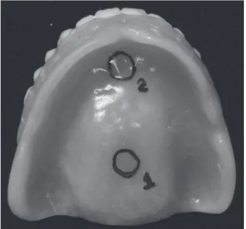 Figure 1. Complete denture with the thin area (1) and thick area  (2) marked for recording the temperature