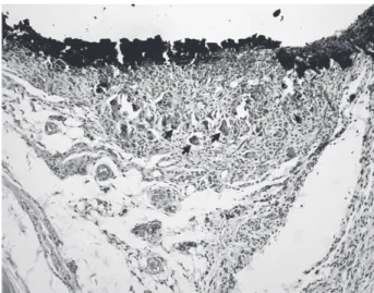 Figure  1.  Sealapex  with  addition  of  ZnO,  7  days. A  moderate  chronic  inflammation  associated  with  residual  material  (HE,  original magnification, ×200).