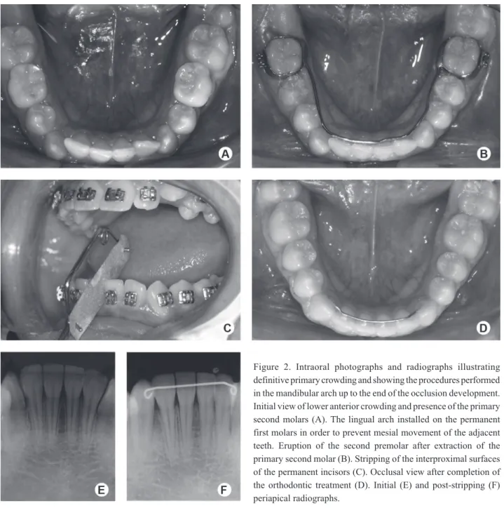Figure 1. Lower intraoral occlusal view illustrating temporary primary crowding: lack of space for both lateral incisors (A), spontaneous  alignment (B), the end of the occlusion development, without the need of any orthodontic intervention (C)