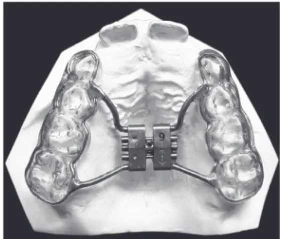 Figure 1. Bonded rapid maxillary appliance used in the study. 