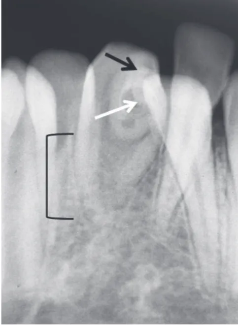 Figure  2.  Mirror  view  of  talon  cusp  on  lingual  surface  of  mandibular left central incisor (arrow).