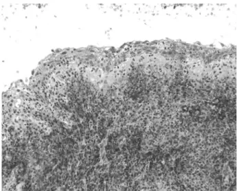 Figure 1. Strong intensity and high expression of syndecan-1 in  the epithelial lining of a radicular cyst