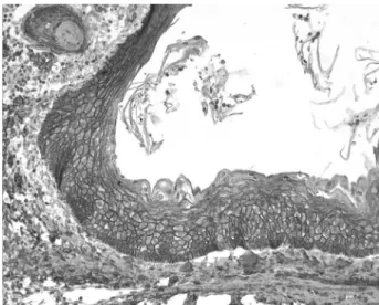 Figure 3. Epithelial cells from a dentigerous cyst presenting strong  intensity and high syndecan-1 expression (original magnification, 