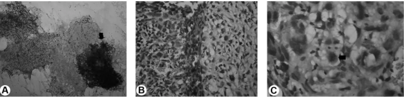 Figure 2. Panel of photomicrographs for microscopic examination. A = Highly cellular and hemorrhagic smear, with clusters of cells  (arrow)