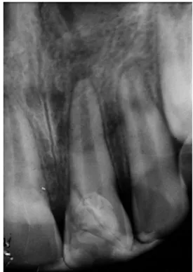 Figure 1. Intraoral view of tooth 21 with a crown-root fracture. Figure 2. Complicated crown-root fracture on tooth 21.